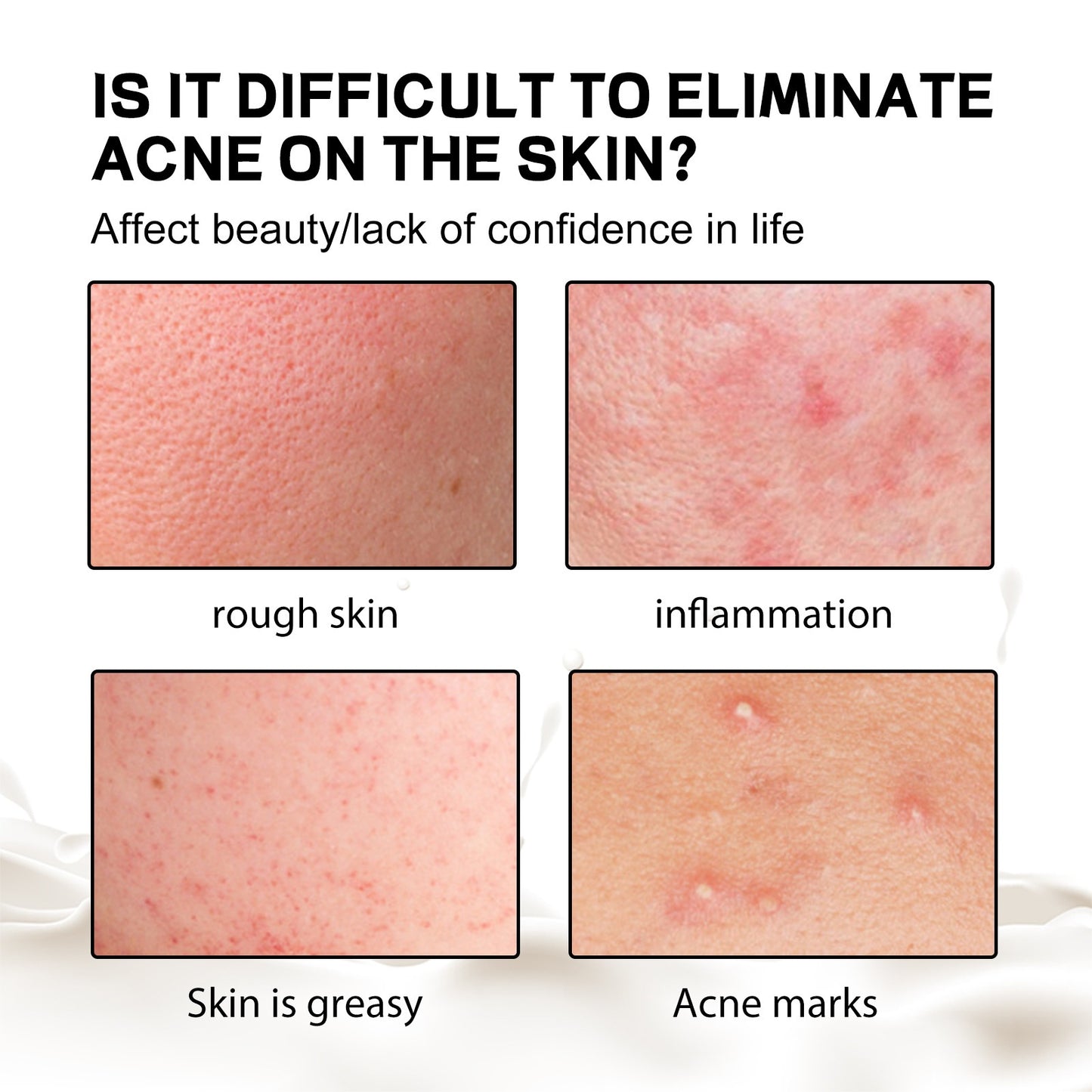 Deep Cleansing, Acne-Treating, and Moisturizing Soap